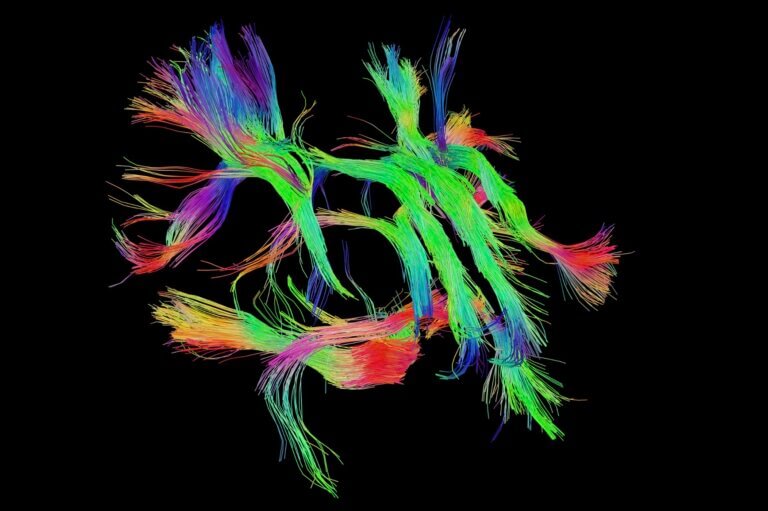 Picture of white matter in the brain.