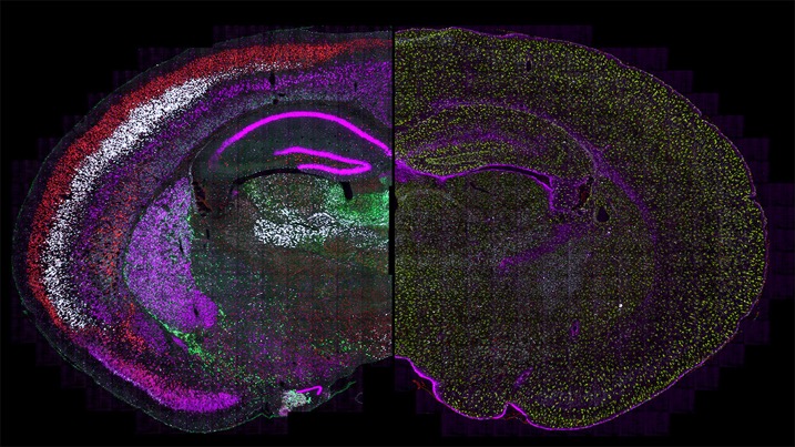 A new study has identified a specific type of human brain cell, known as a projection neuron, that is most vulnerable in late-stage multiple sclerosis. Here, projection neurons are shown in dark red in the mouse brain on the left, with astrocytes (another type of brain cell) on the right side of the image. Image courtesy of David Rowitch.