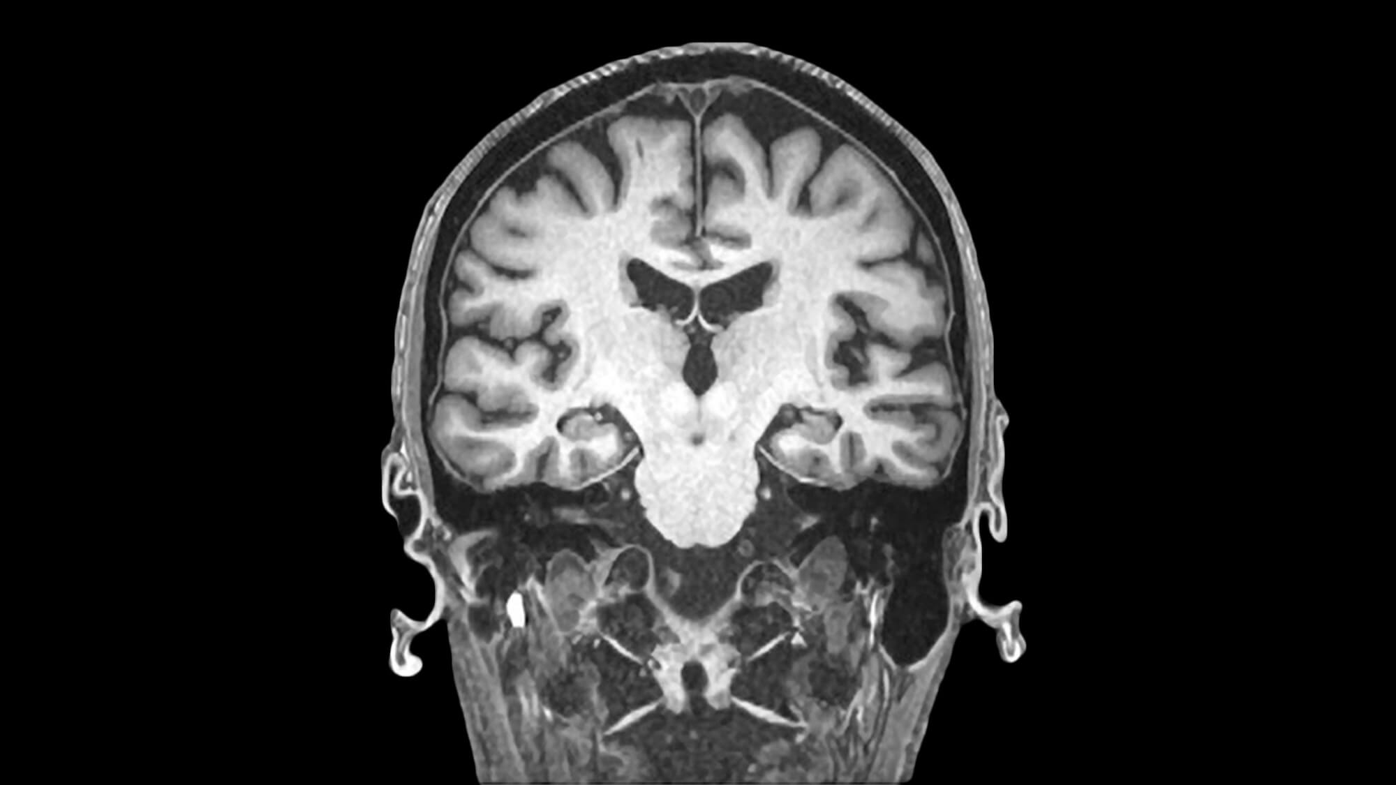 Image of human skull taken via MRI