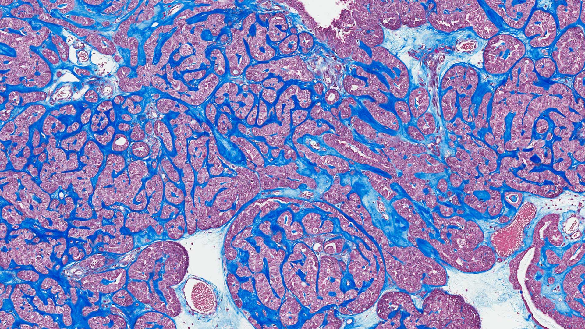 Cancer tissue