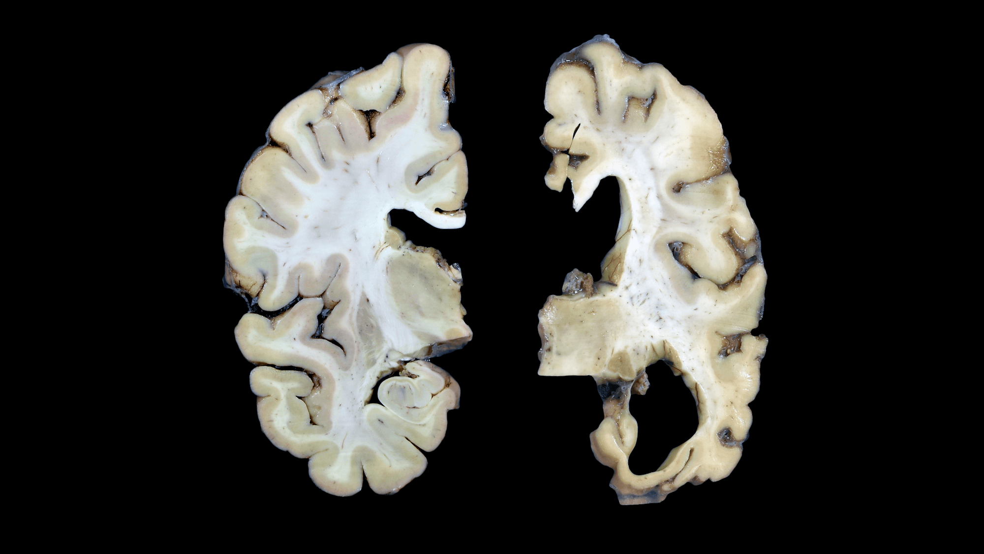 Sections of a healthy human brain (left) and a brain from a patient with Alzheimer’s disease (right).