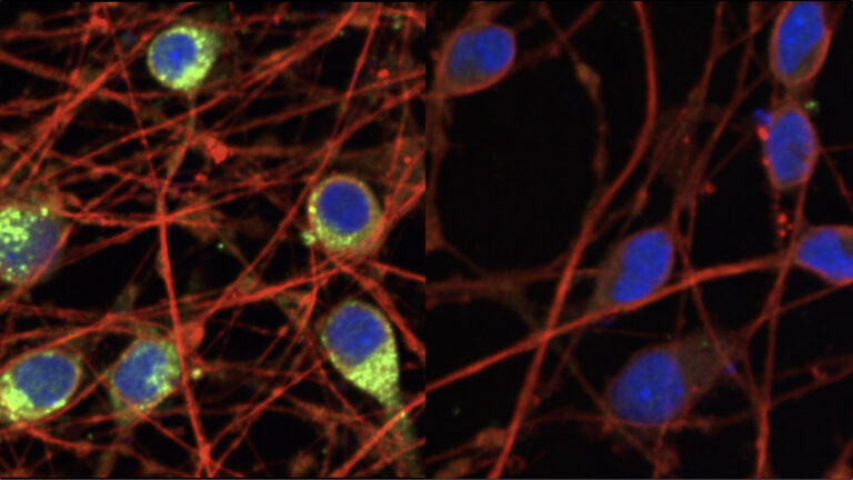 The CRISPR interference technique allows new explorations of human cells. Here, Allen Distinguished Investigator Martin Kampmann, Ph.D., and his colleagues used the method to reduce levels of a dementia-associated protein known as progranulin, shown in green on the left, in human neurons by dialing down the progranulin gene in the cells on the right. (Image adapted from Tian et al (2019) Neuron 104:239)