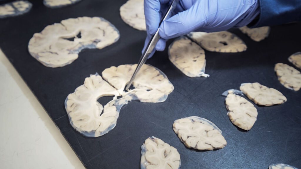 Alzheimer's disease samples from human brain donors.