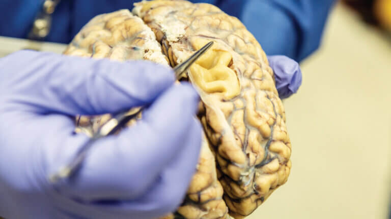 UW Medicine pathologist C. Dirk Keene, M.D., points out large grooves in the surface of a brain of someone who died from Alzheimer's disease and donated their brain to research. In a healthy brain, these folds would nestle right up against each other but in Alzheimer's, neuron death leads to noticeable shrinkage in many parts of the brain. Keene is part of a collaborative effort to find the cellular roots of Alzheimer's. Photo by Erik Dinnel / Allen Institute