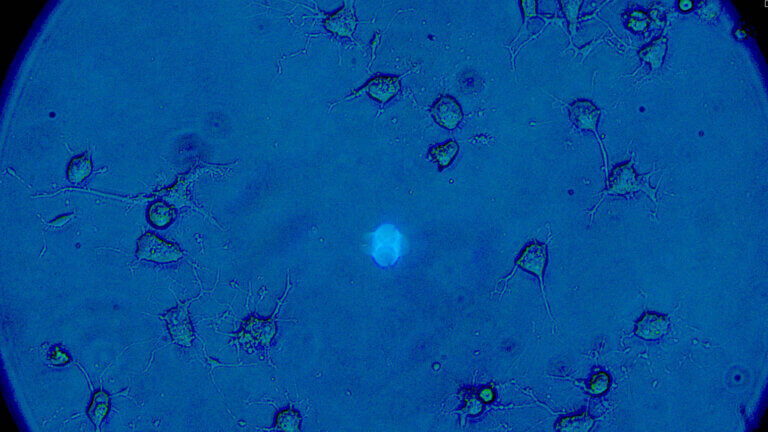 Image of ovarian cancer cells and their invadopodia from a microscope