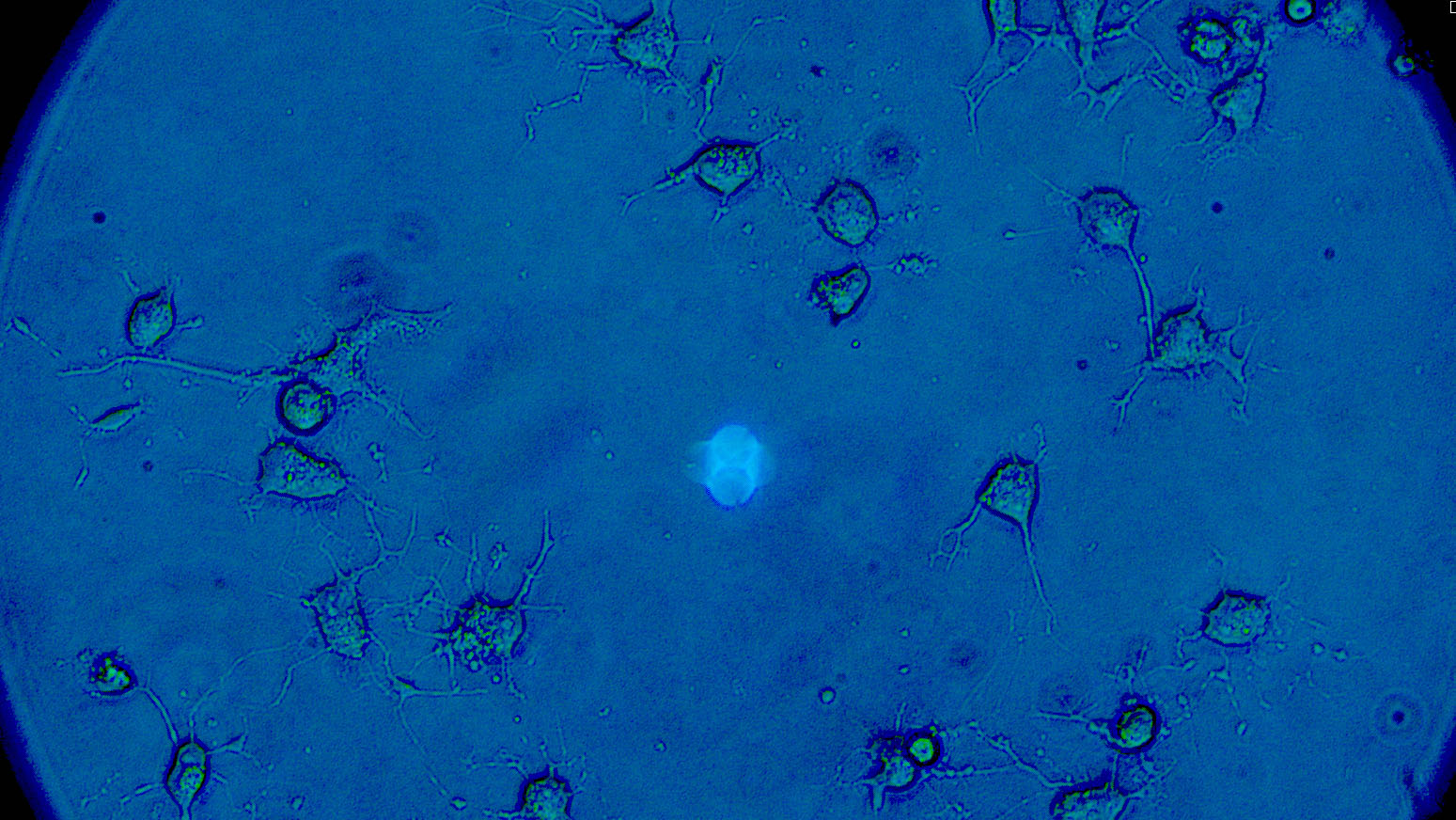 Image of ovarian cancer cells and their invadopodia from a microscope