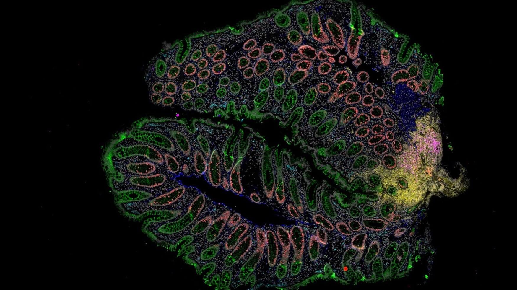 This piece of large intestine, biopsied from a pediatric IBD patient, has been processed to reveal cellular and molecular features we can use to understand disease activity. These include epithelial cells (green), muscle (dark blue), T cells (lavender and purple), B cells (yellow), monocytes and macrophages (cyan), and cells that are actively dividing (red).