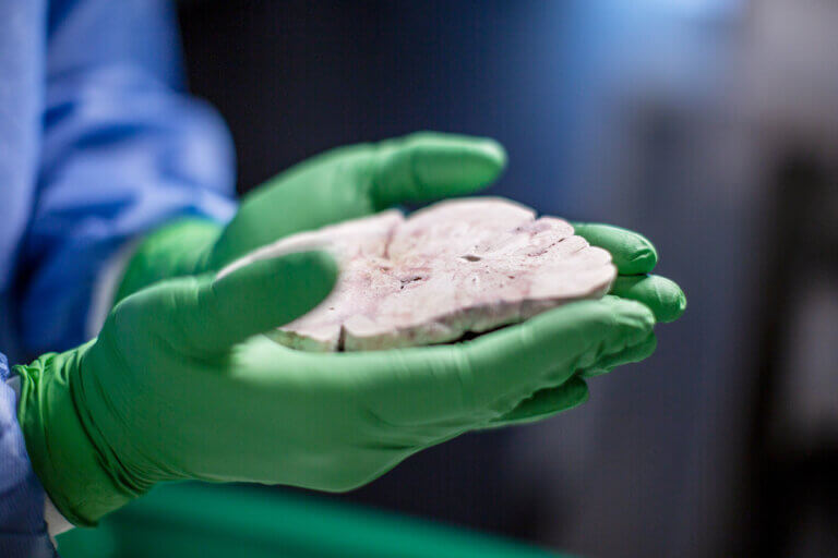 gloved hand holding human brain slice