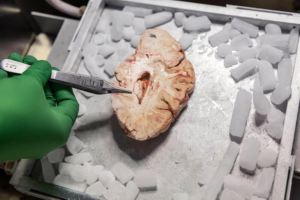 slice of human brain on tray with ice and forceps touching it.